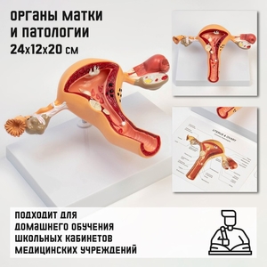 Анатомическая модель «Макет матки с патологиями», 24×12×20 см